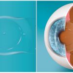 Implant chambre posterieur